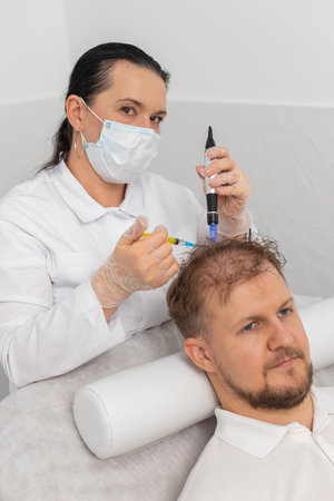 Alopecia. Man hair loss improve growth treatment regeneration, dermapen microneedling vitamin...
