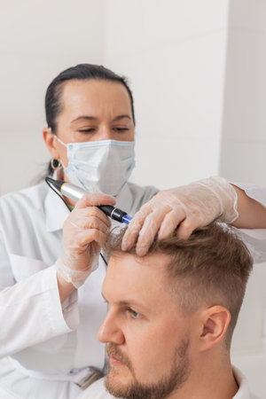Alopecia balding. Man hair loss improve growth treatment regeneration, dermapen microneedling,...