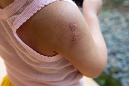 impetigo on a child's shoulder caused by Streptococcus and Staphylococcus bacteriaの写真素材