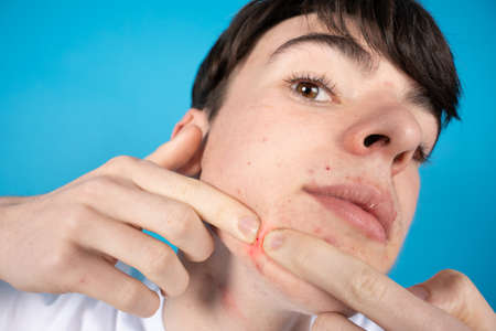 Closeup of teenager exploding a pimple. Dermatology and acne problems in adolescence concept.の写真素材