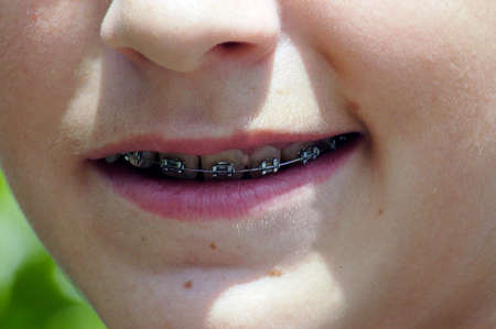 Orthodontic treatment with braces for a young person