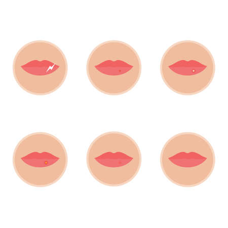 Stages of herpes.のイラスト素材