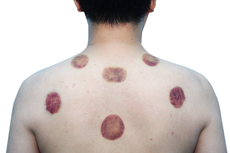Asian man 43 years old with marking of vacuum cupping, sport therapyの写真素材