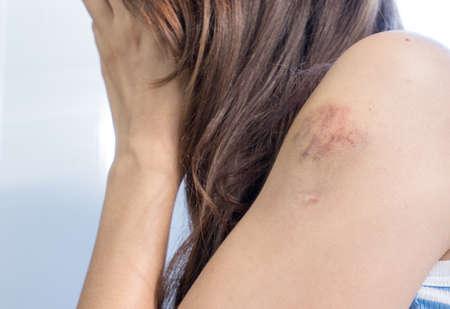 Bruises on the hand of a woman with dark hair in a striped white-blue T-shirt close up.の写真素材