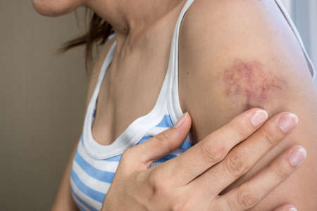 Bruises on the hand of a woman with dark hair in a striped white-blue T-shirt close up.の写真素材