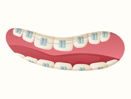 Isolated cartoon illustration of open mouth with teeth and dental braces.のイラスト素材