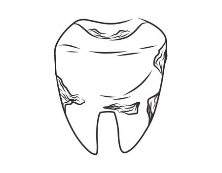 Hand-drawn vector illustration of a decayed tooth. Black and white sketch depicting tooth decay, dental cavities, and oral health problems. Medical, educational, and dentistry-related designs.のイラスト素材