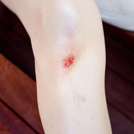 Female knee with bloody scratch and bruiseの写真素材