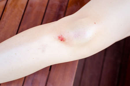 Female knee with bloody scratch and bruiseの写真素材