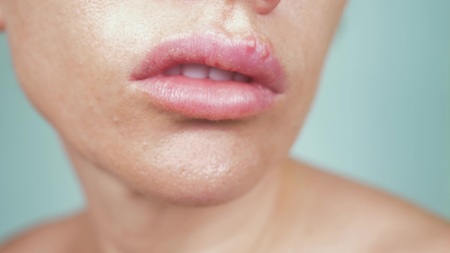 herpes on the female lips. close-up, blue background, blur