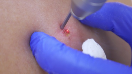 the doctor dermatovenereologist burns a birthmark on the back of a man with a laser beam. close-up.の写真素材