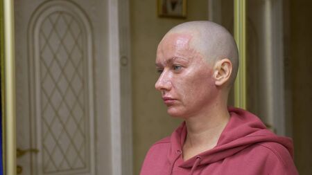 bald exhausted woman on a blue background looks at the camera. she feels awkward due to her falling hair. concept of oncology and the effects of chemotherapyの写真素材