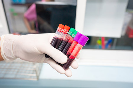 Hands of a medical technologist wearing rubber gloves holding a tube to collect a patient's blood...