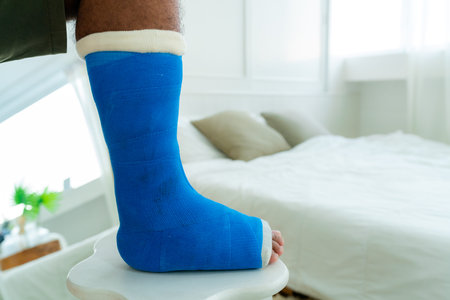 On the right side of the right foot, a man who had a fractured bone accident had a blue cast wrapped...