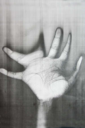 handicapped hand の写真素材