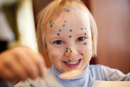 smiling child is ill a chicken poxの写真素材