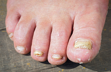 Fungus Infection on Nails of Man's Foot