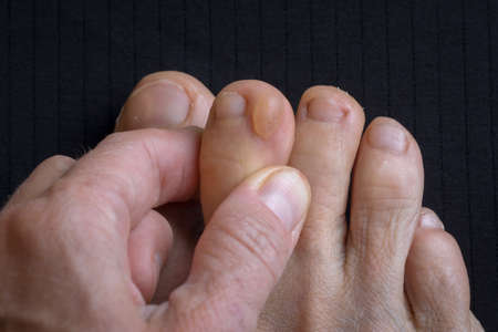 big callus on a woman's dirty foot, closeup photo of callus, feet surface injuryの写真素材