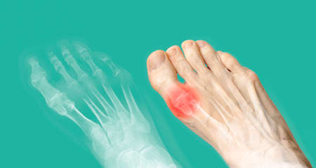 X-ray and the same foot with red pain. Rheumatoid arthritis. Osteoarthritisの写真素材