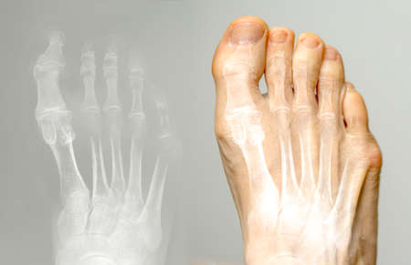 X-ray and the same foot. Hallux varus condition.の写真素材