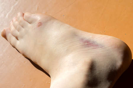 Bruise from sprain on leg