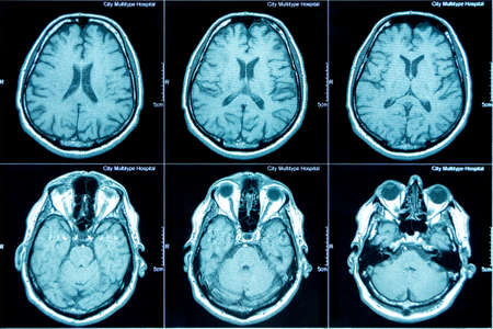 MRI scan of the brain, medical examination of the brain