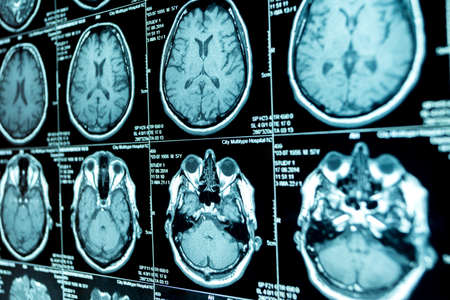 MRI scan of the brain, medical examination of the brainの写真素材