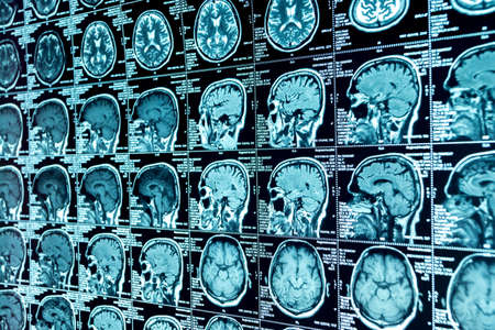 MRI scan of the brain, medical examination of the brain