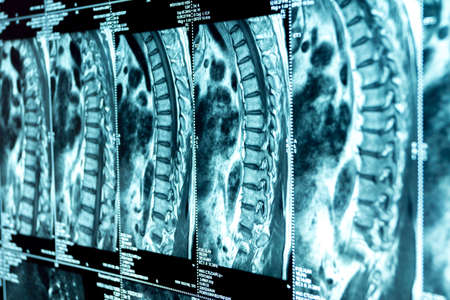MRI of the thoracic spine, medical examinationの写真素材