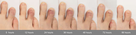 Growth and healing of a bruised toe within four daysの写真素材