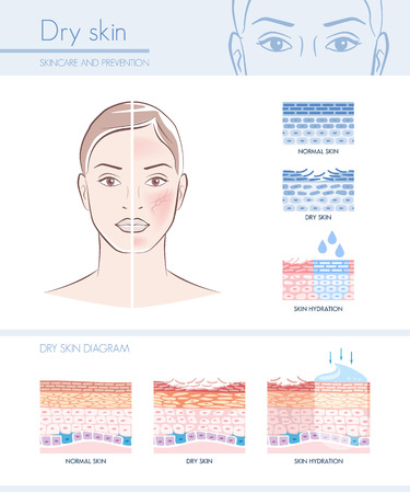 Dry skin hydration infographic with skin diagram; skincare and beauty conceptのイラスト素材