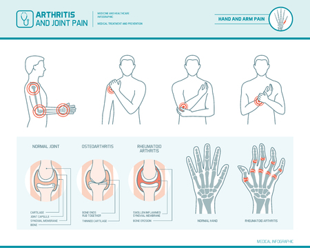 Arthritis and joint pain infographic, anatomic illustration of an inflammed hand and armのイラスト素材