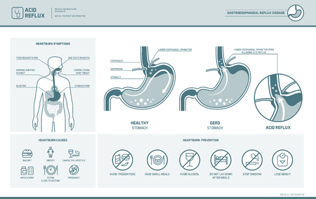 Acid reflux, heartburn and gerd infographic with stomach medical illustration, symptoms, causes and preventionのイラスト素材
