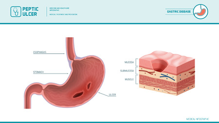 Stomach and peptic ulcer: inflamed sore on the stomach mucous membrane, stomach lining cross section diagram, medical illustrationのイラスト素材