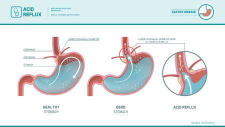 Acid reflux, heartburn and gerd infographic with medical illustration: stomach acid moving up into the esophagus causing acid reflux symptomsのイラスト素材