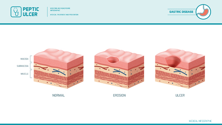 Stomach erosion and peptic ulcer stages infographic: stomach lining and mucosa cross section diagram, medical illustrationのイラスト素材