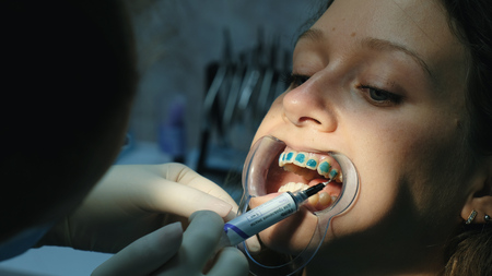 Dentist applies orthodontic blue glue on the teeth to the woman in the latch before installing the bracket system close-up. Visit to the stomatologist orthodontistの写真素材