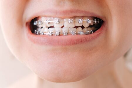 Female mouth with braces close-up, correction of malocclusionの写真素材