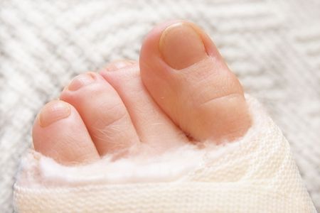 Four pinkies sticking out of the white cast. Shallow depth of field.の写真素材