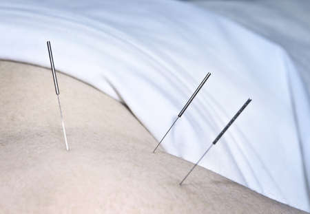 Closeup of acupuncture needles inserted in man's shoulderの写真素材