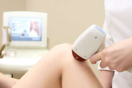 Laser turbo epilation. Medical procedure.の写真素材