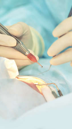 Ophthalmology laser microscope operation. Doctor in clinic. Patient eye treatment. Myopia and...