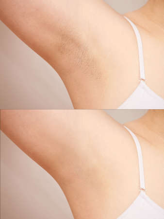 Girl underarm. White woman armpit. Before and after epilation. Wax depilation result. Laser hair removal. sugaring spa procedureの写真素材