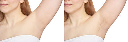 Girl underarm. White woman armpit. Before after epilation collage. Wax depilation result concept. Laser hair removal. sugaring spa procedure. Health care home routine. IPL treatment. Copyspace bannerの写真素材