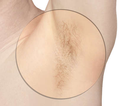 Girl underarm. White man armpit. Before epilation collage. Wax depilation result concept. Laser hair...