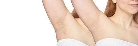 Girl underarm. White woman armpit. Before after epilation collage. Wax depilation result concept. Laser hair removal. sugaring spa procedure. Health care home routine. IPL treatment. Copyspace bannerの写真素材