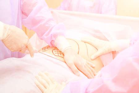 Surgery room. Belly surgery. Doctor mark liposuction area at tummy. Drawing at skin. Anti cellulite...