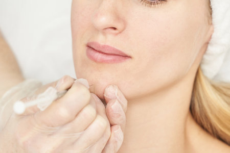 Injection at spa salon. Doctor hands in gloves. Closeup. Pretty female patient. Beauty treatment. Healthy skin procedure. Young women face. Plasmolifting rejuvenationの写真素材