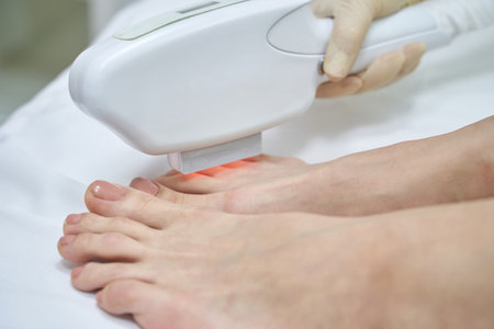 Close-up of laser hair removal treatment on feet in spa setting for smooth skin care and beauty routine.の写真素材