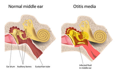 Otitis ear anatomy of the human disease vectorのイラスト素材